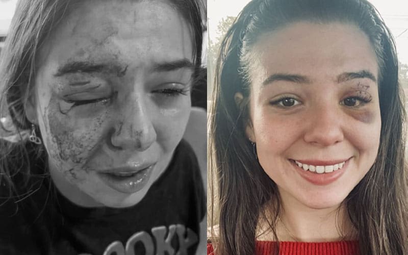 Eddie Guerrero's daughter Kaylie reveals great progress in healing dog bite